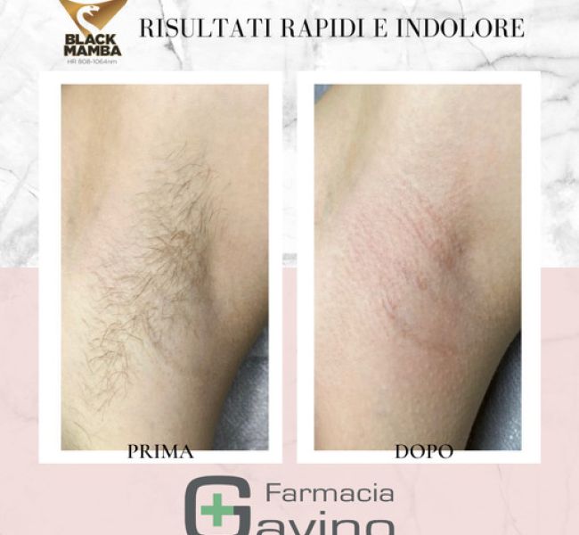 Epilazione laser efficace e veloce | Farmacia Gavino 