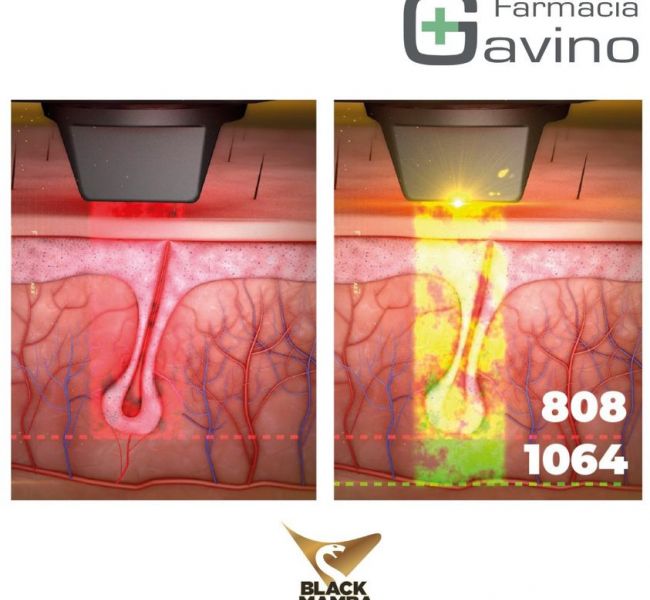 👉Laser epilazione doppia lunghezza d’onda👈 | Farmacia Gavino 